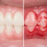 Glossaire Dentaire : Gencives, Gingivite, Parodontite et Maladies Buccales